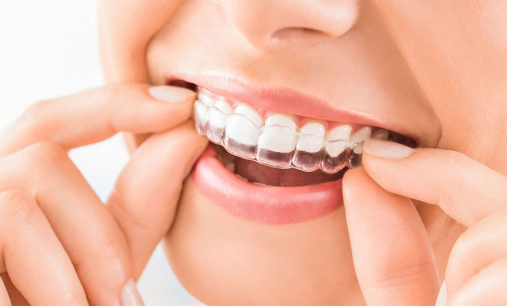 The Invisalign Advantage