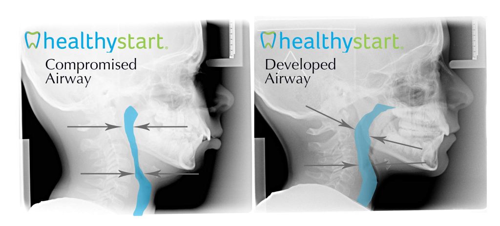 Compromised-vs.-Developed-Airway