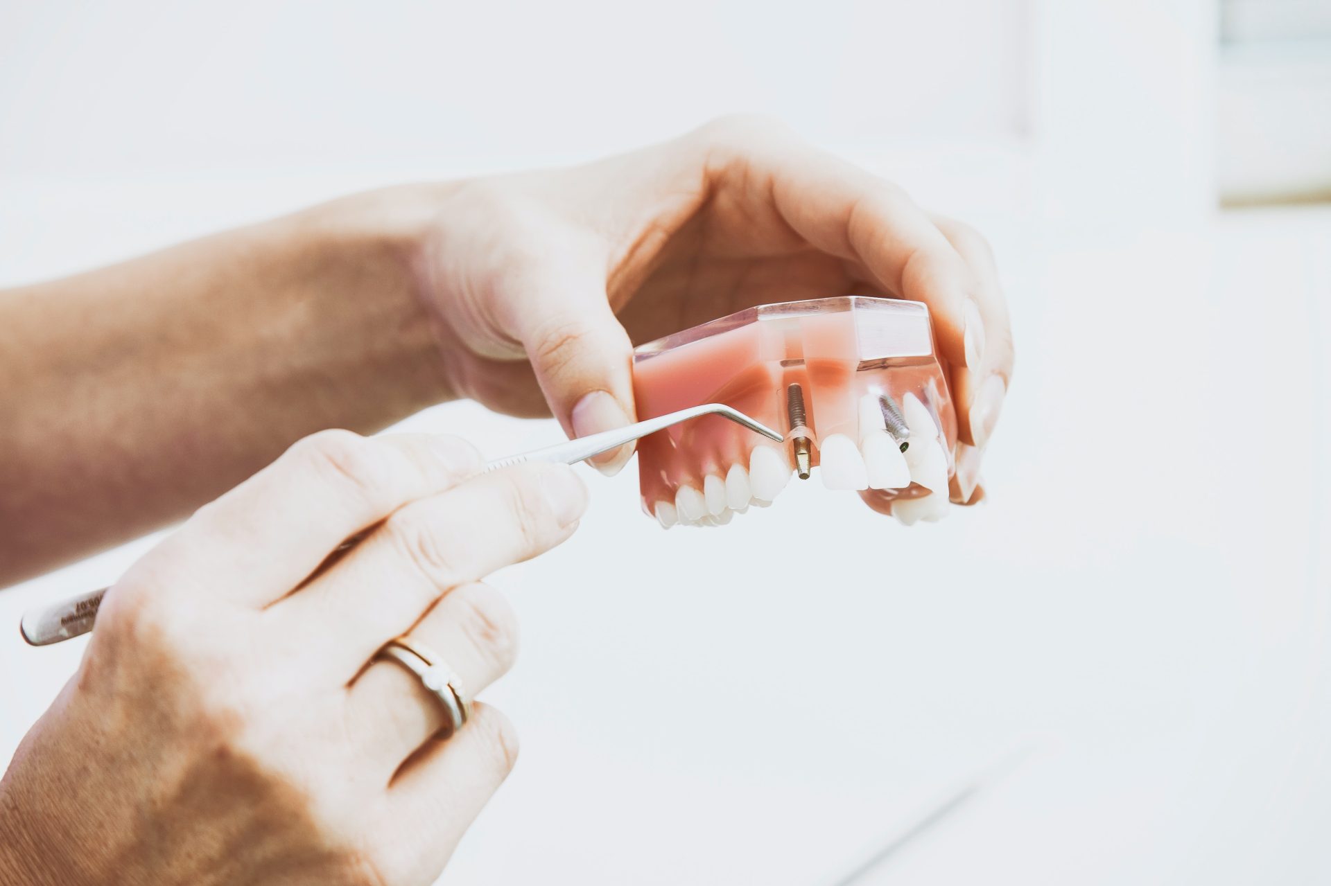 dental implants vs. veneers